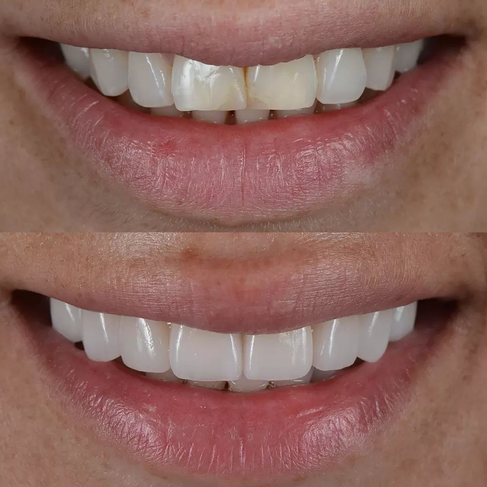 Dentysta estetyczny tworzący idealny uśmiech w Turcji