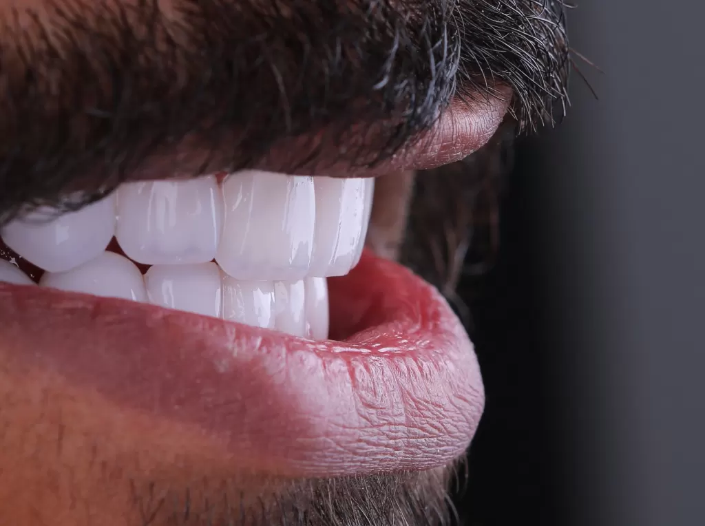 Порцелянові коронки, VDC Dental Clinic