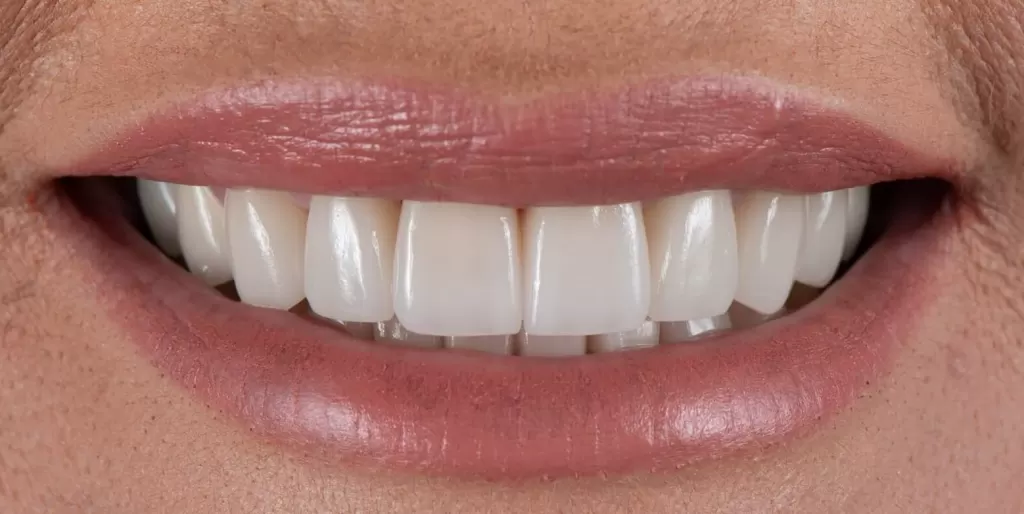 Smile makeover after treatment