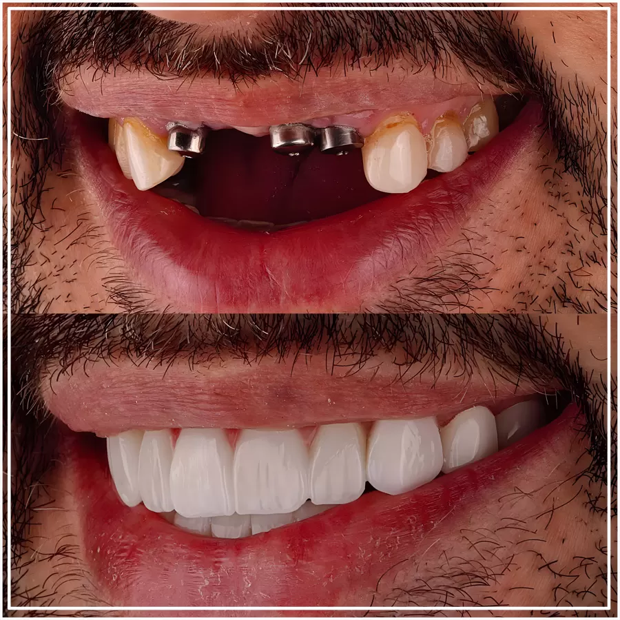 Dental implants before and after: abutments on the implants, then the fixed new teeth