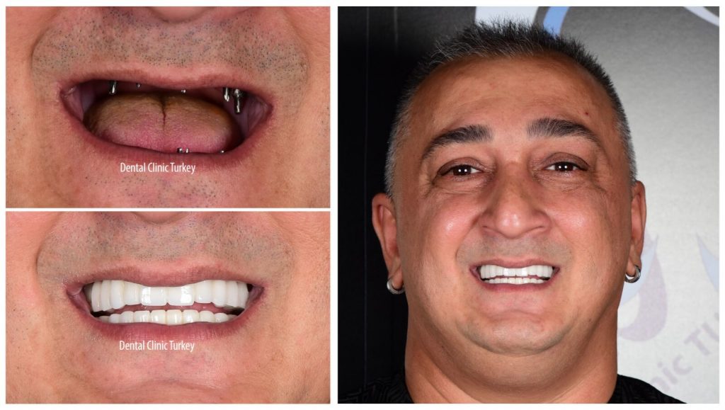 All On 6 Dental Implant Procedure In Turkey Cost Advantages all-on-6-dental-implant-procedure-in-turkey-cost-advantages
