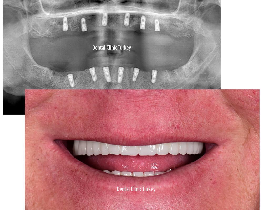 all on 6 dental implant surgery
