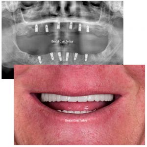 all on 6 dental implant surgery