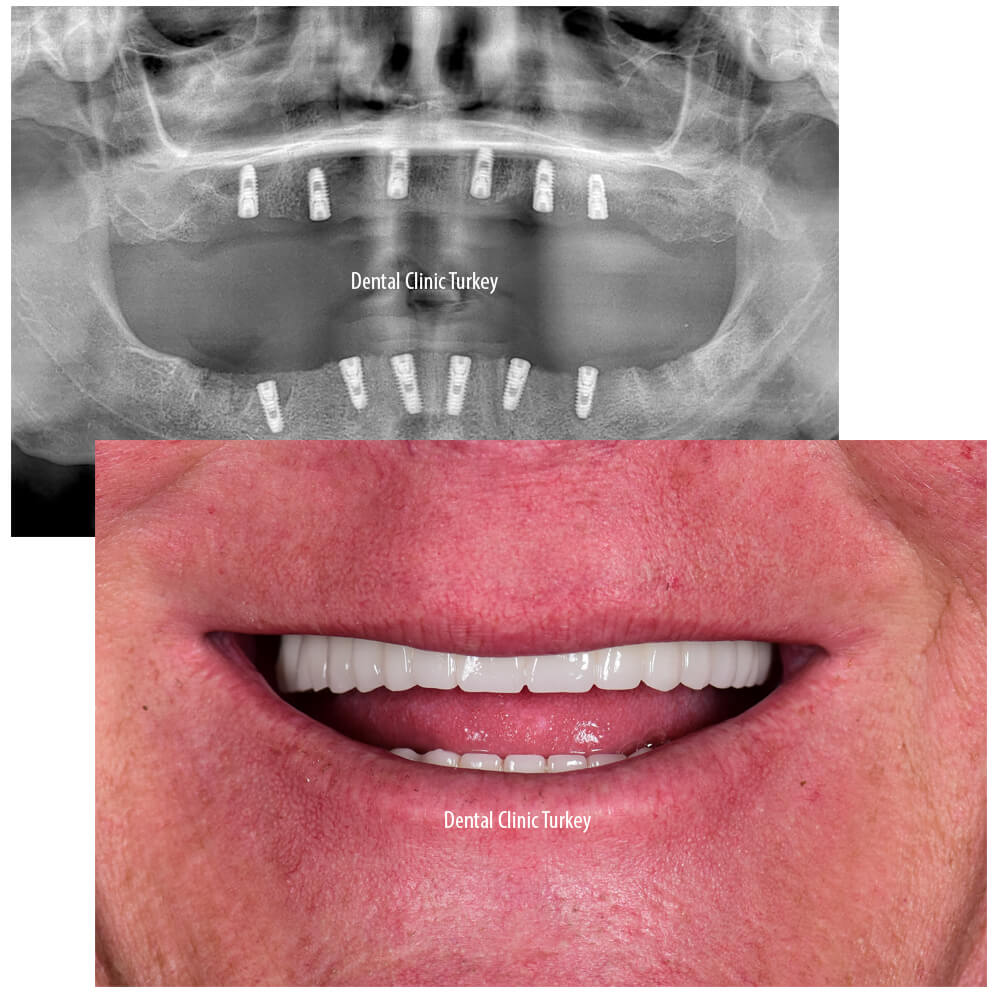 all on 6 dental implant surgery