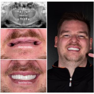 full mouth dental implants
