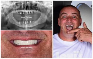 full mouth implants restorations
