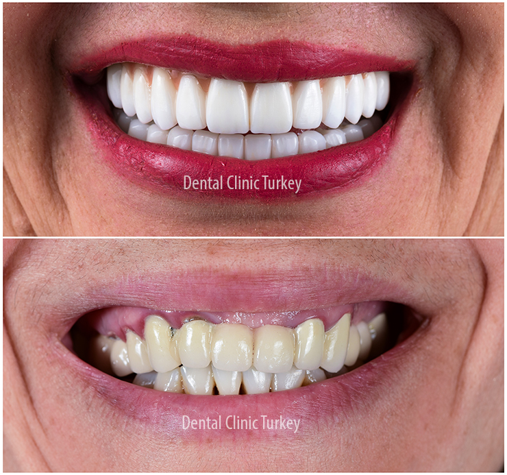 Dental on sale hollywood smile