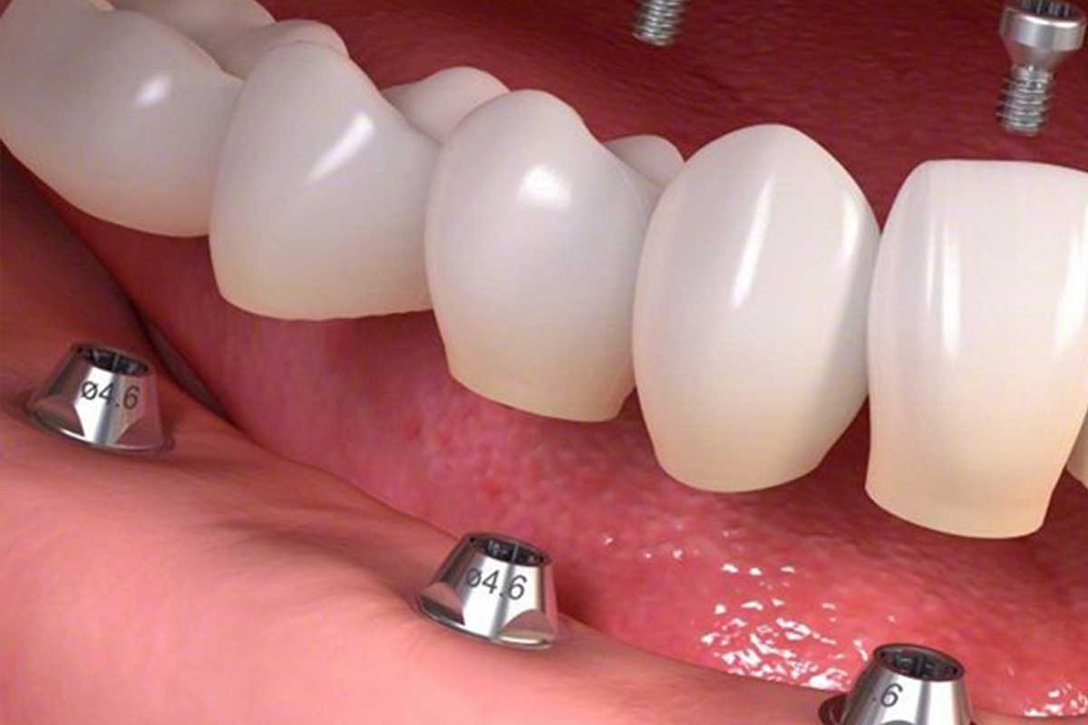 dental implant care