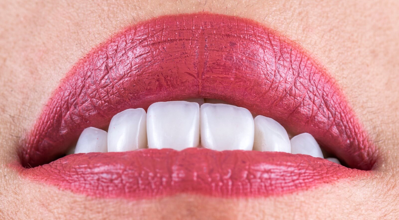 porcelain crowns emax