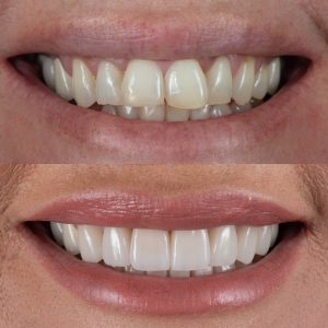 Porcelain Veneers