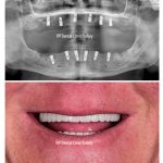dental treatment in turkey