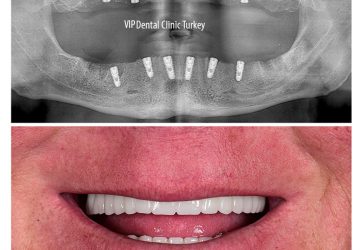 dental treatment in turkey