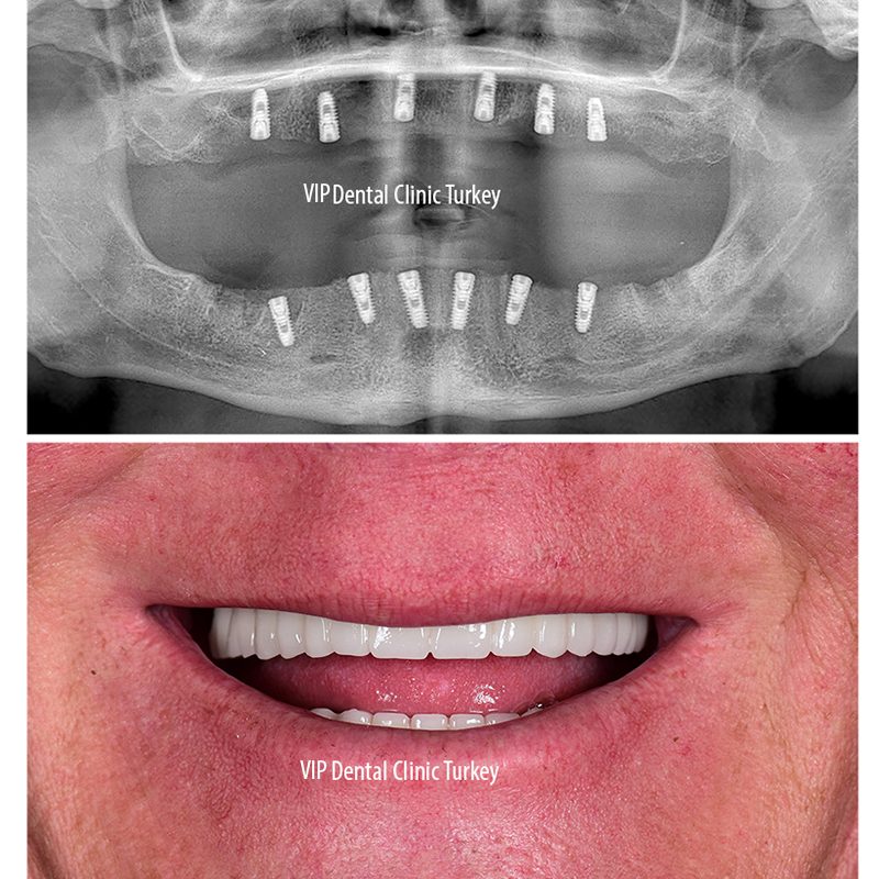 dental treatment in turkey