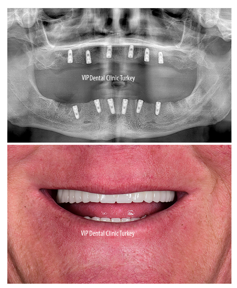 dental treatment in turkey