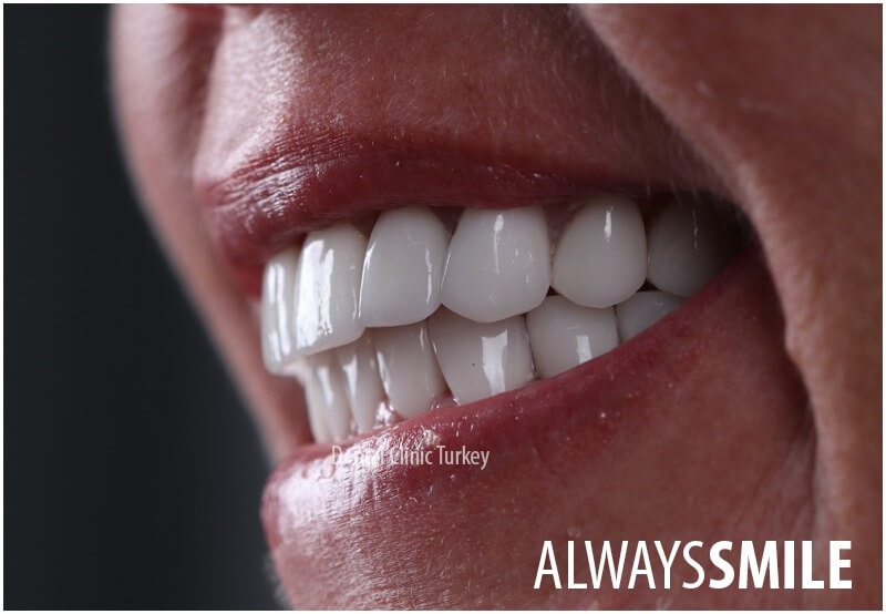 zirconium crowns and zirconium veneer