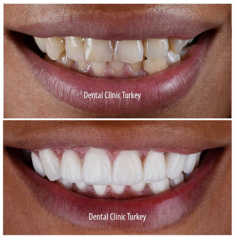 Zirconia, Couronnes en zirconium