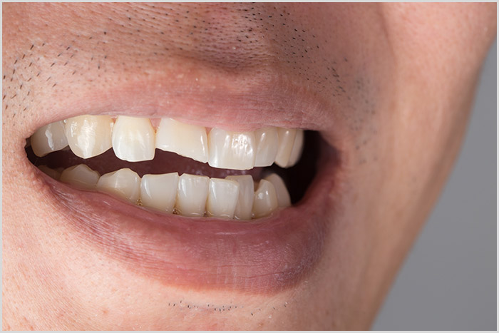 Broken Tooth