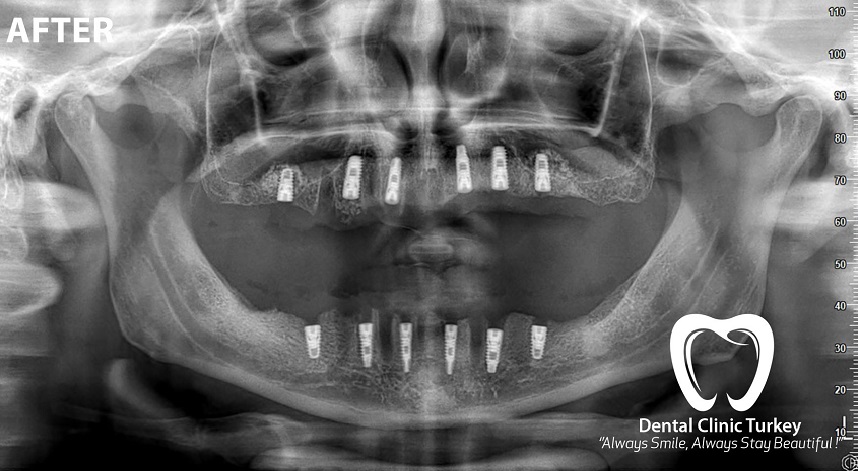 Radiographie Panoramique
