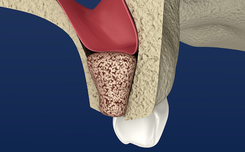 sinus lifting