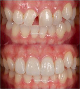 What are the Treatment Options for Broken Tooth