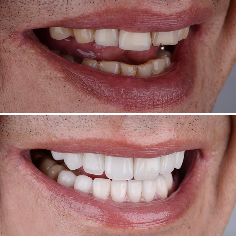Dental Smile Hollywood Smile in Turkey, Antalya Cosmetic Dentist