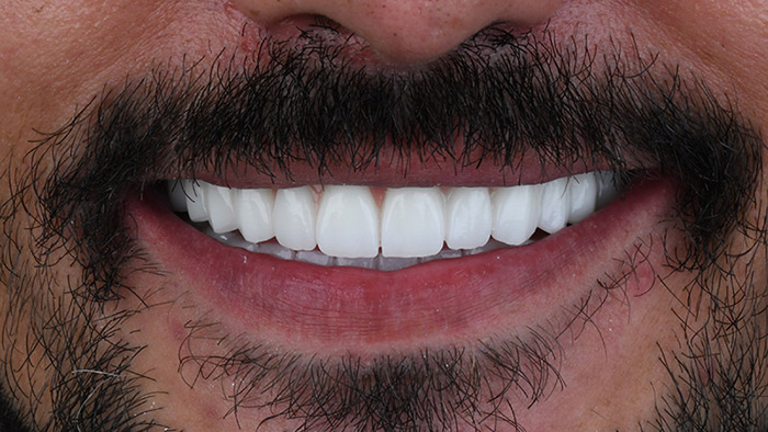 Dental Veneer in Turkey