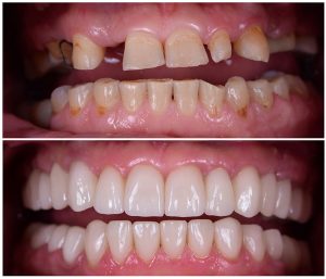 Dentaire Bouche Complète