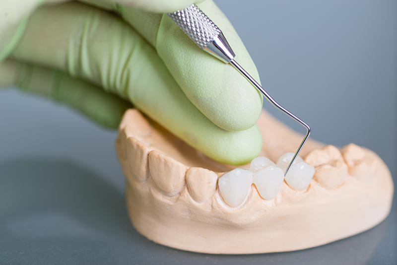 dental crown applied