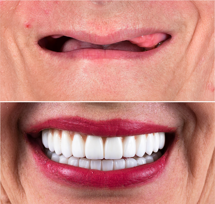 Dental Implant in One Day Turkey Dental Clinic, Dentist Antalya