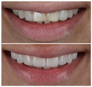 dental treatment in turkey
