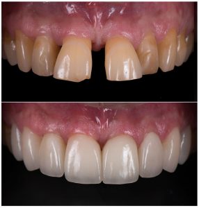 dental treatment before and after