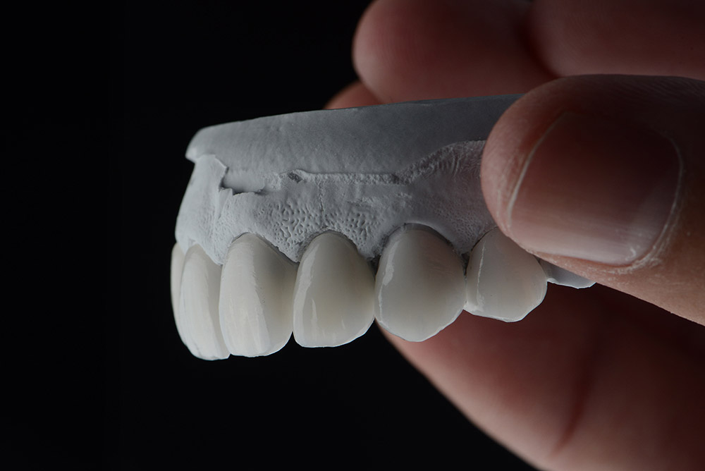 Aesthetic Tooth Filling