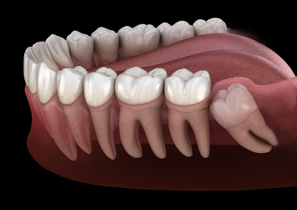 Wisdom Tooth Surgery