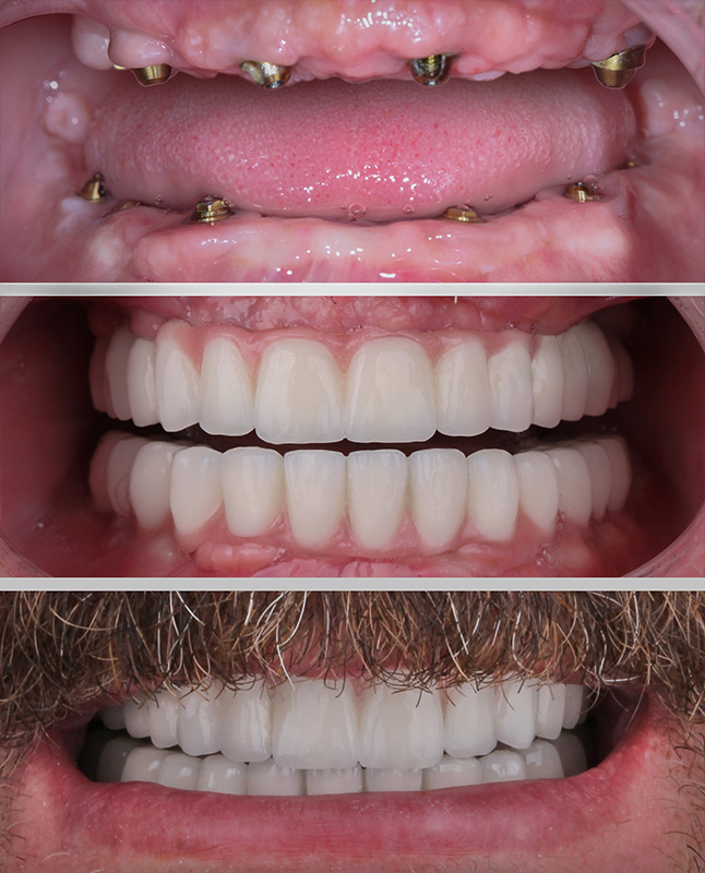 All-on-4 implantante