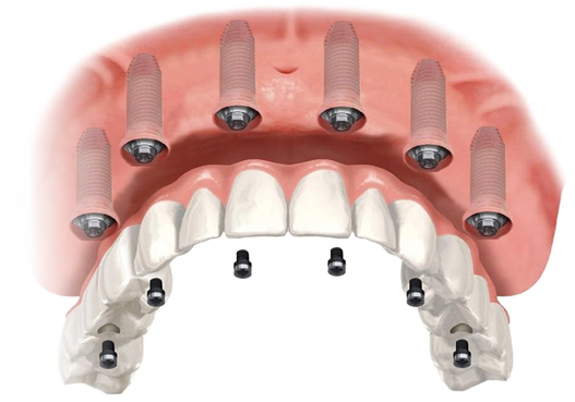 all on six implant