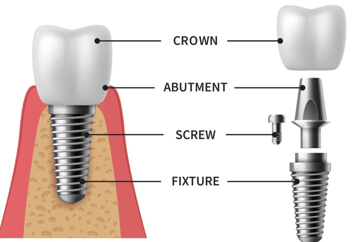 Implant Dentaire en Turquie