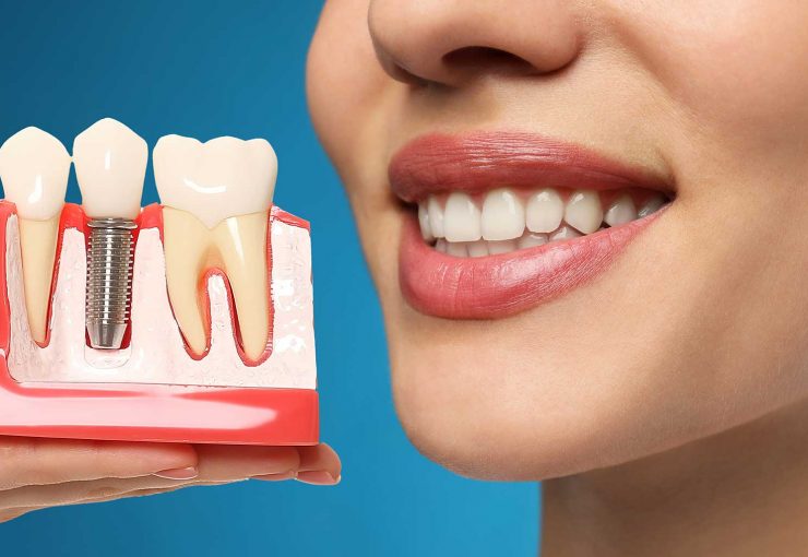 Avantages et Inconvénients des Implants Dentaires