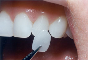 porzellanveneer