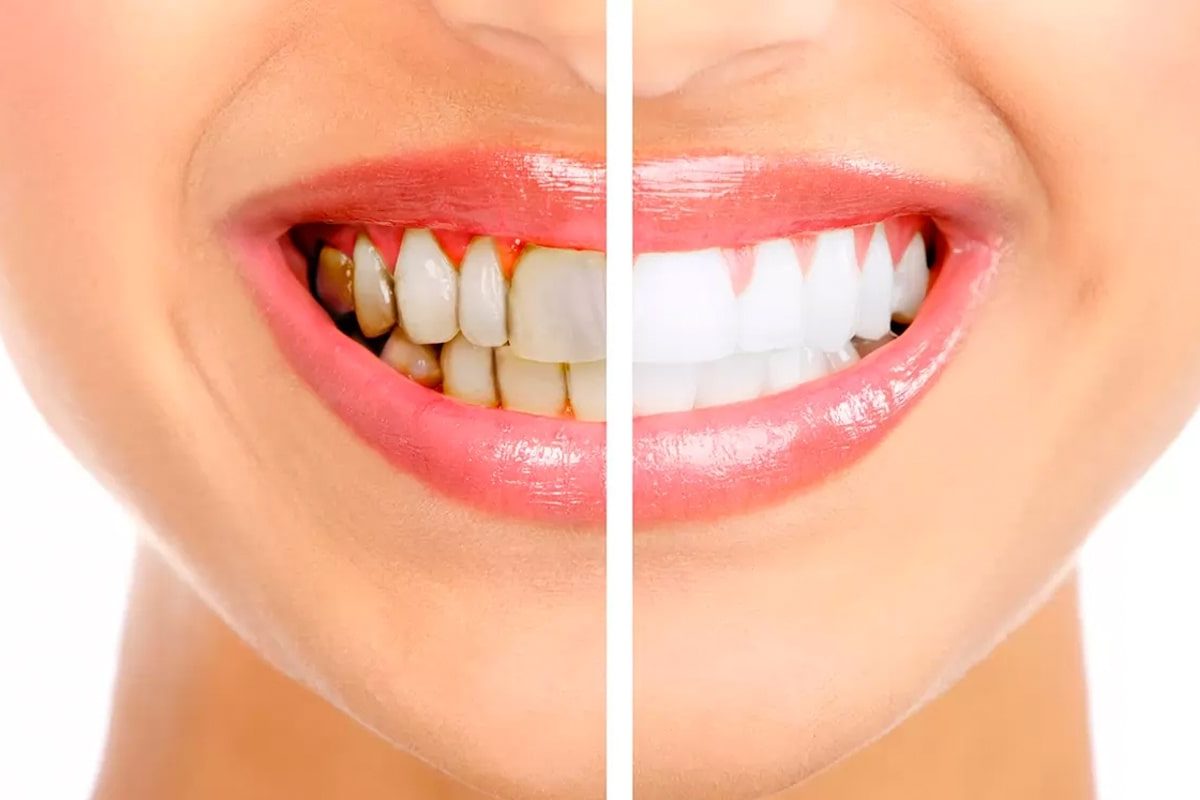 Teeth Cleaning