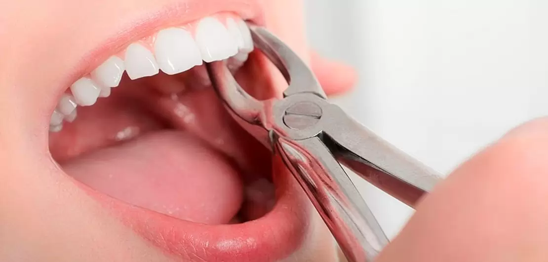 Extraction Dentaire, les points auxquels il faut faire attention