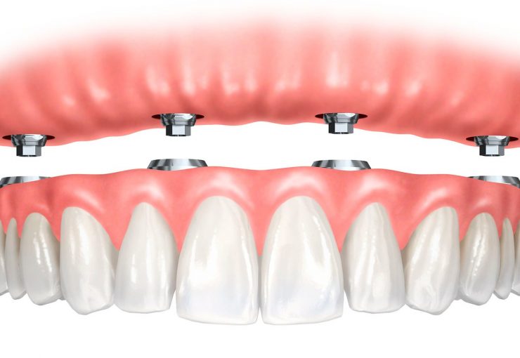Combien De Temps Dure Le Traitement Implantaire ?
