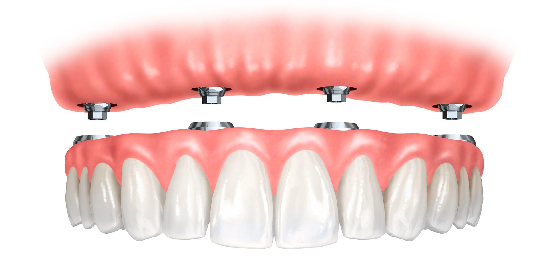 Combien De Temps Dure Le Traitement Implantaire ?