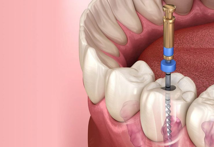 Qu'Est-Ce Que le Traitement de Canal ?