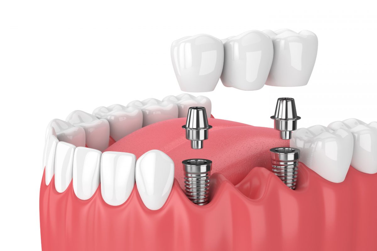 Qu'est-Ce Qu'un Implant Dentaire ?