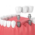 Qu'est-Ce Qu'un Implant Dentaire ?