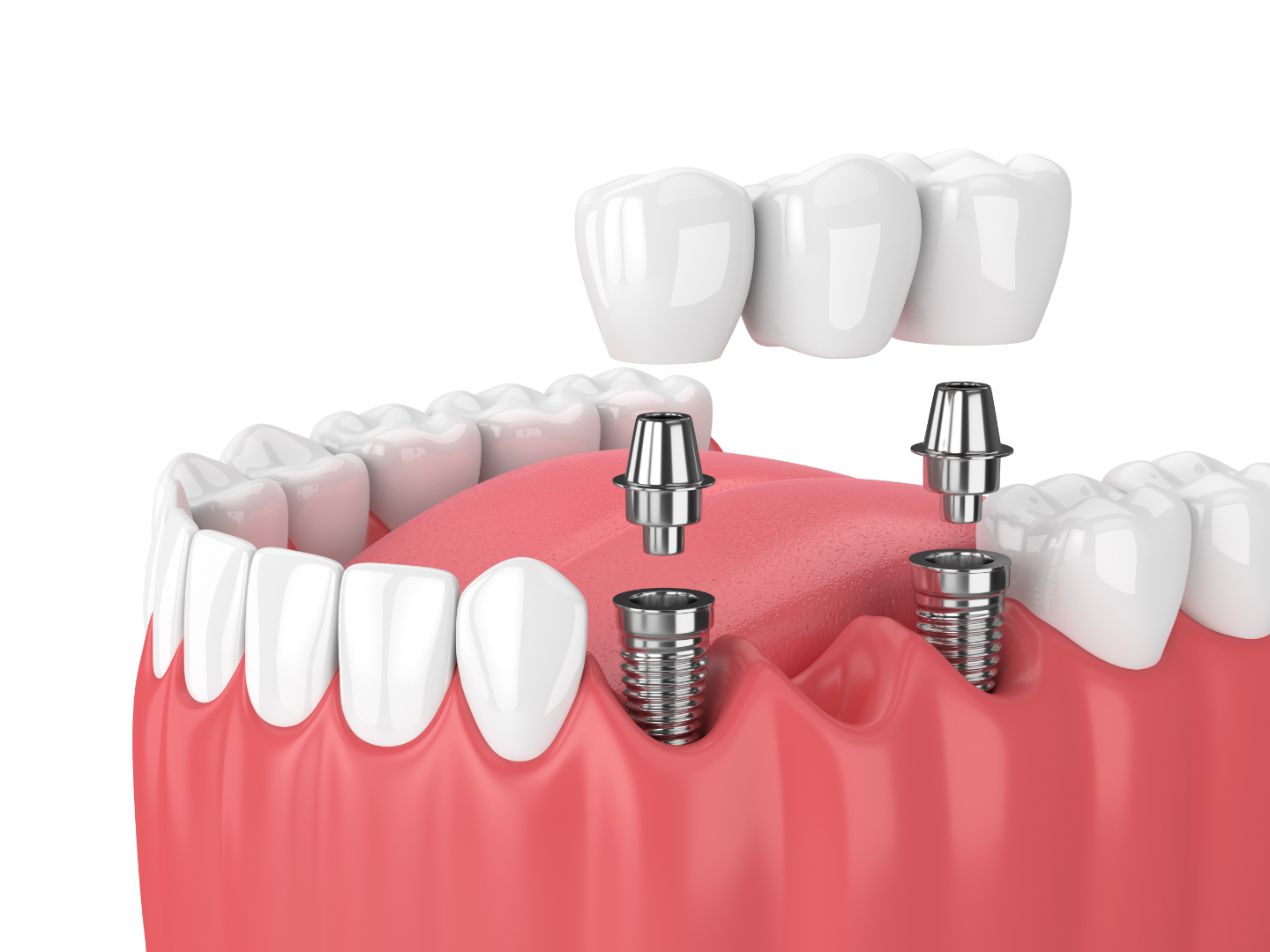 Qu'est-Ce Qu'un Implant Dentaire ?