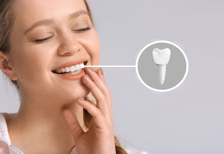 missing tooth and implanted teeth