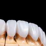 Dental Veneer in Turkey, Antalya