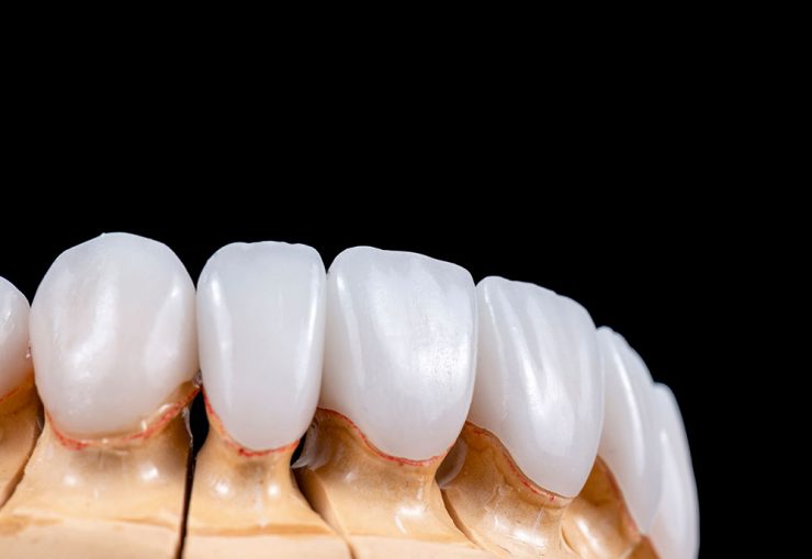 Dental Veneer in Turkey, Antalya