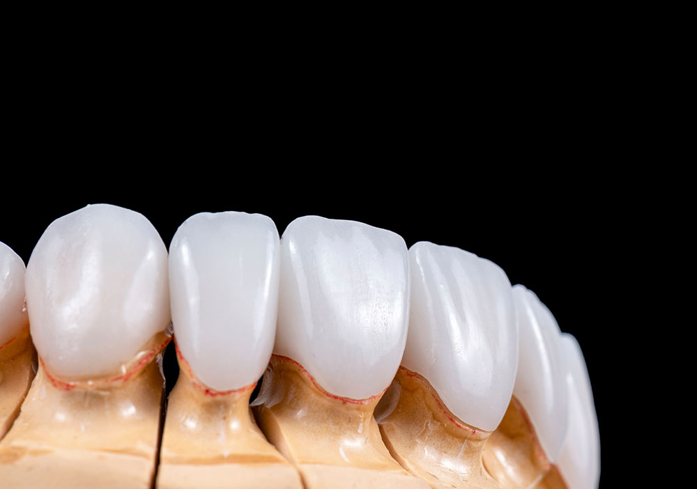 Dental Veneer in Turkey, Antalya